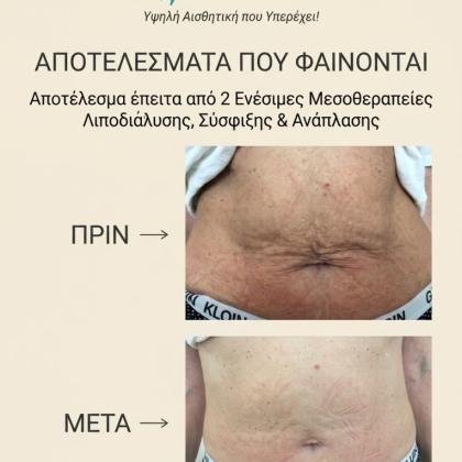 Mairi Sarris Beauty Before After Vrilissia